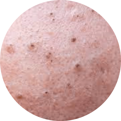 Blackhead Acne